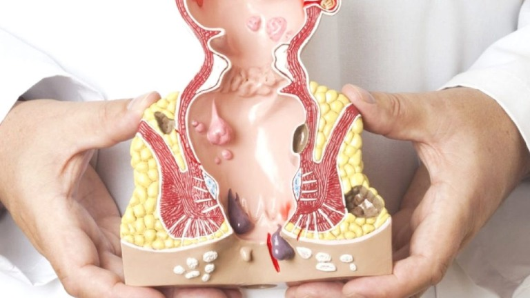 biểu hiện của bệnh trĩ