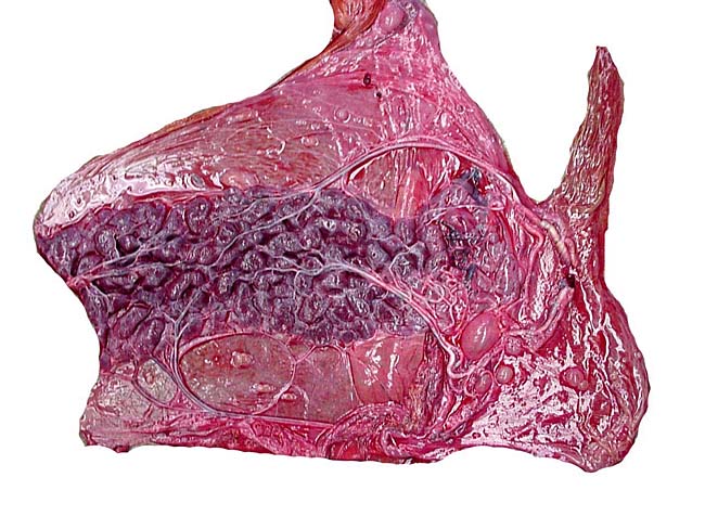 Placenta of the second, surviving lion twin