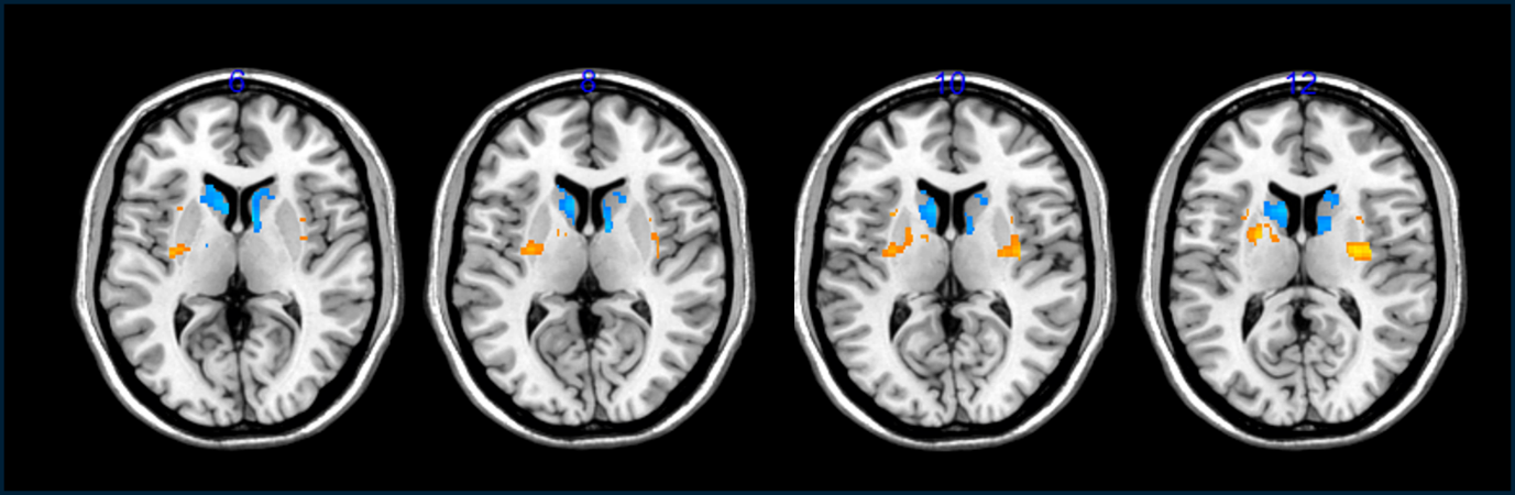 four brain scans with target areas of treatment colored