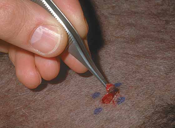 The sample is removed by grasping its base with a forceps and cutting it