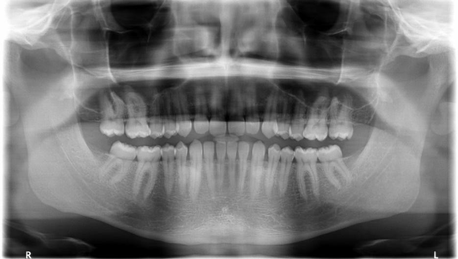 Normal orthopantomogram (OPG) | Radiology Case | Radiopaedia.org