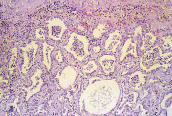 Subpleural fibrosis and epithelialization.