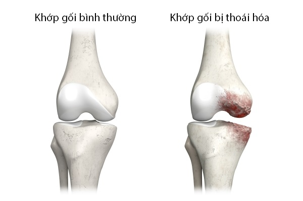 dược phẩm điều trị thoái hóa khớp gối