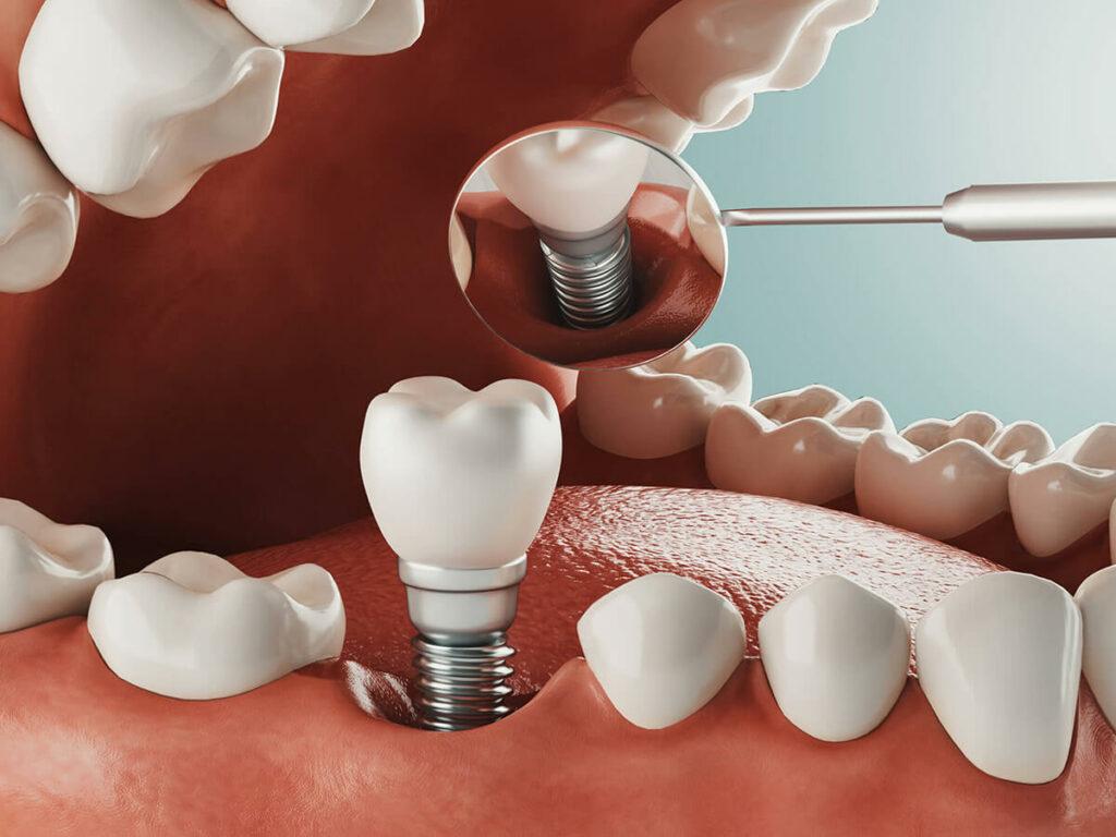 dental implant in North York
