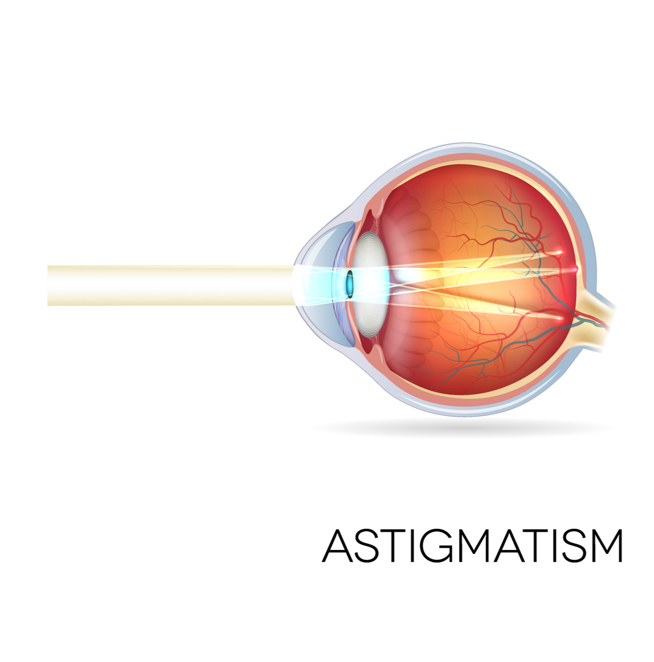 Astigmatism eyesight diagram