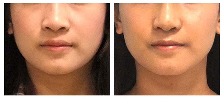 lip reshaping before and after surgery_01.jpg