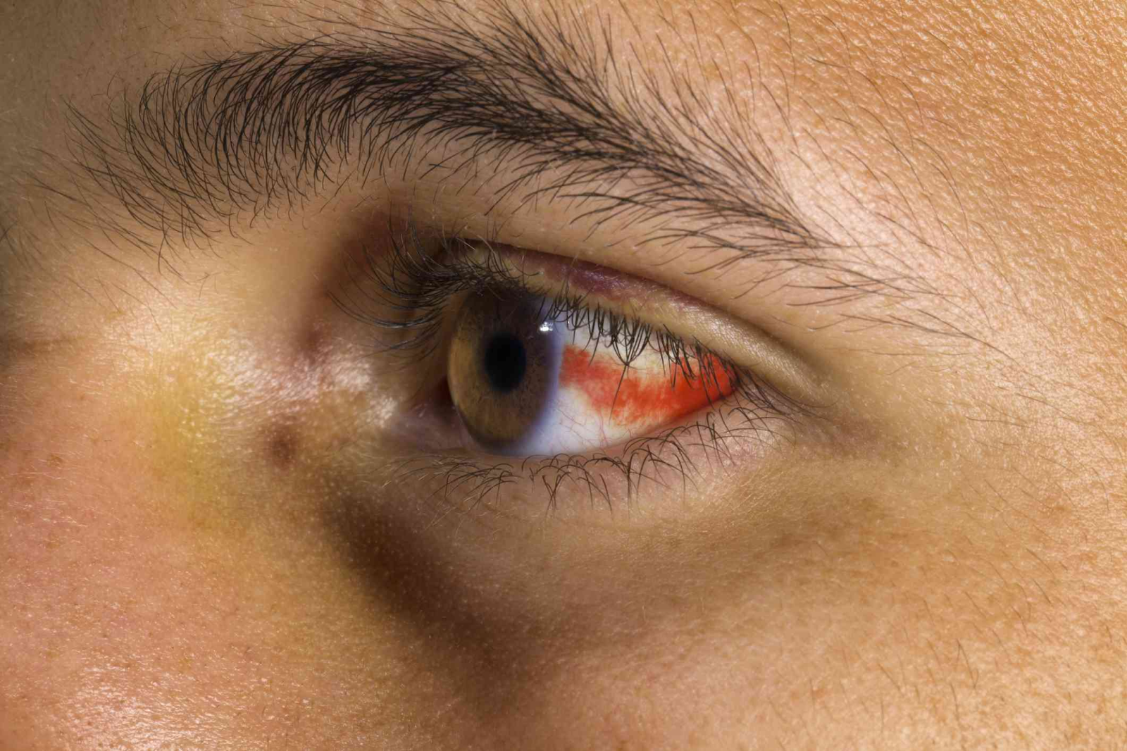 Subconjunctival Hemorrhage