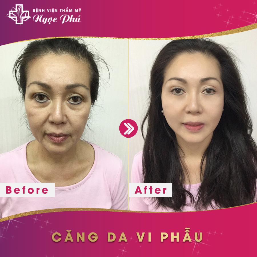 Hình ảnh trước và sau của khách hàng sau khi căng da mặt bằng chỉ tại Thẩm Mỹ Việt Nam