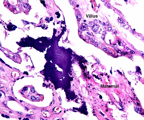Focal regions of calcification (dark blue) occur mainly at the upper tips of the endometrial fibrous septa