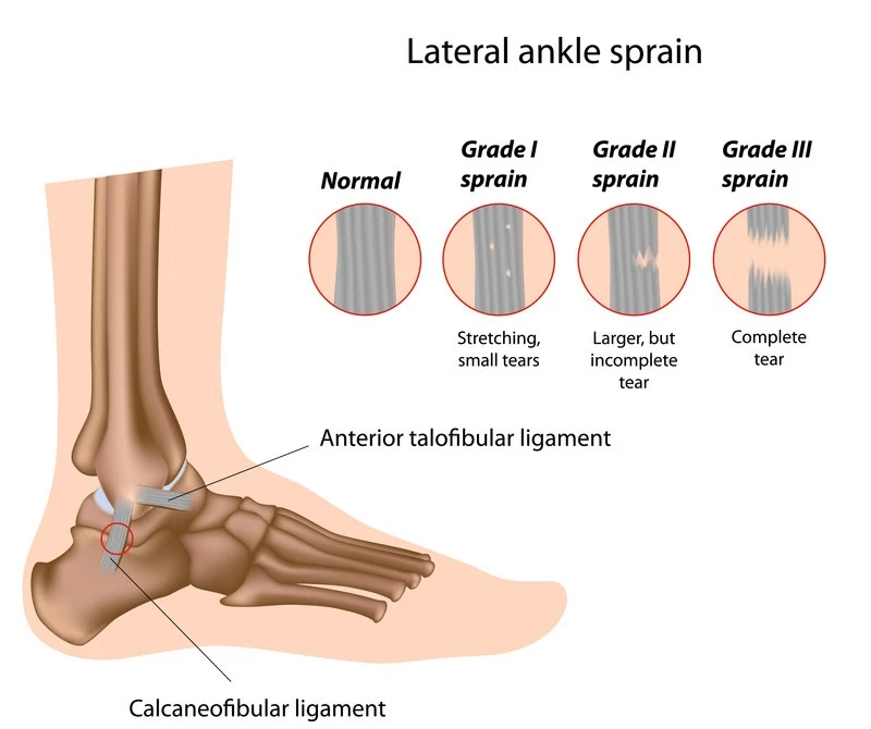 Ankle Sprain Rehab - Symmetry Physical Therapy Downtown Miami