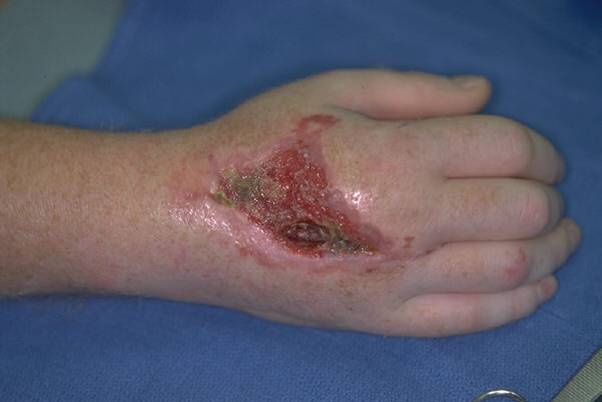 Open wound on dorsum of the hand