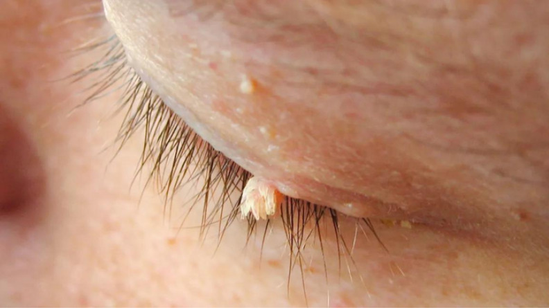 Mụn cóc (mụn cơm) dạng sợi mảnh xuất hiện gần mí mắt và môi