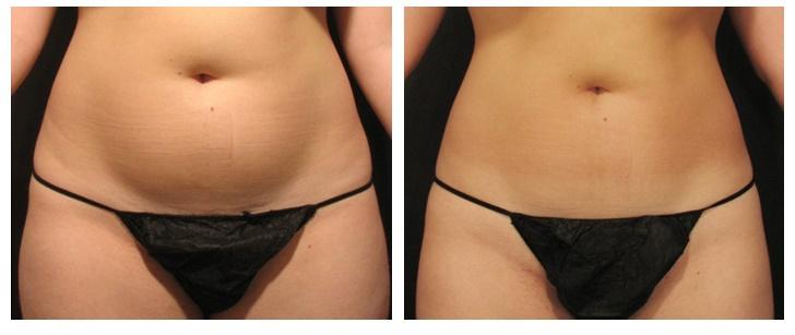 Velashape 3 aplicado en abdomen