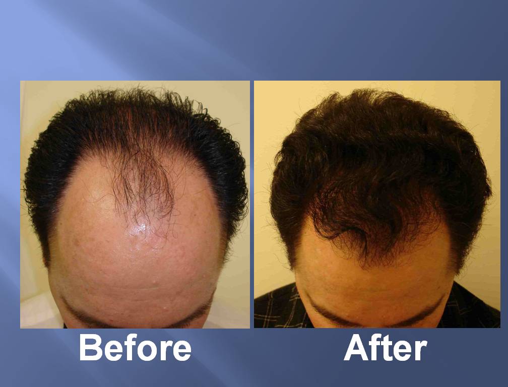 Hair-Transplant-Before-After-Pictures-3.jpg