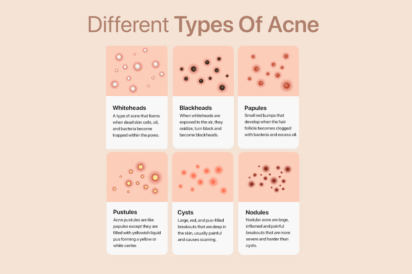 Still Suffering From Acne At Age 40? Read This. | Onecare
