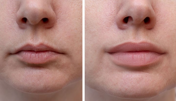 How Long After Lip Fillers Can You Wear Lipstick