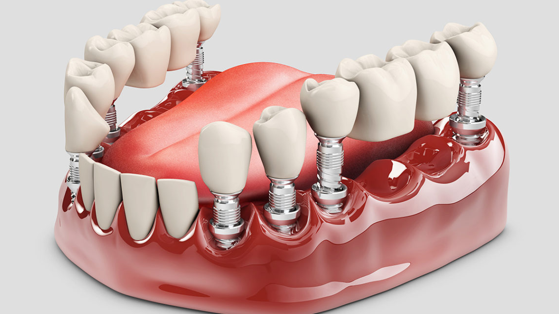 affordable dental implant center in Vancouver