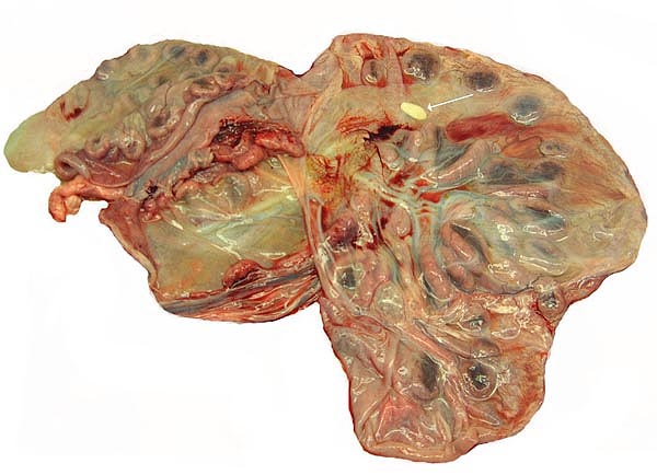 Opened uterus with the attached placenta and yellow hippomanes