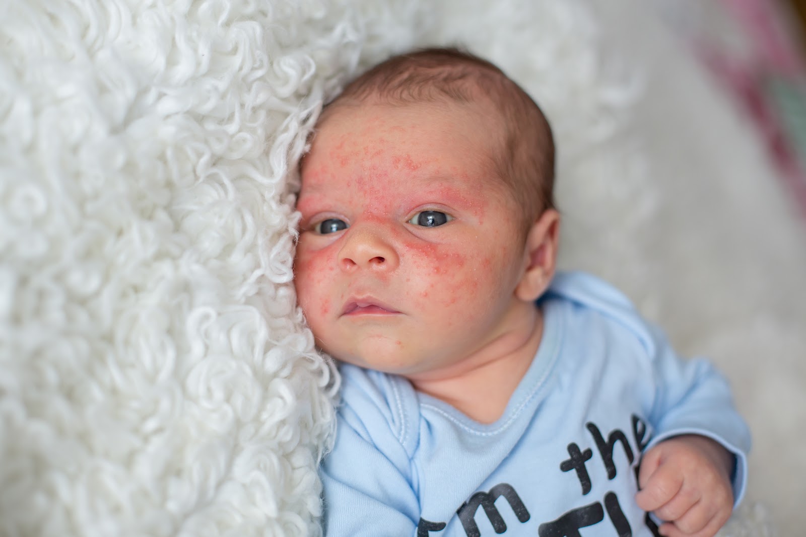 Image of baby with eczema on their face.
