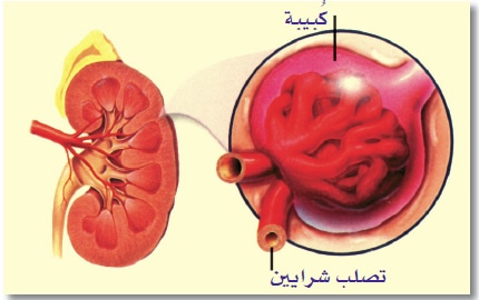 مضاعفات وأعراض ارتفاع ضغط الدم - ويب طب