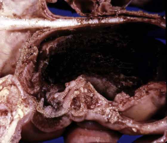 Hemorrhagic cystic cavity lined by granulation tissue that replaces normal turbinate tissue; ethmoid hematoma.