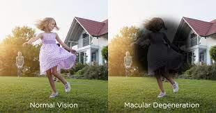 Protecting Your Vision From Age-Related Macular Degeneration - Malik Eye  Care