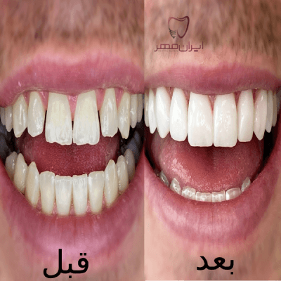 عکس کامپوزیت دندان