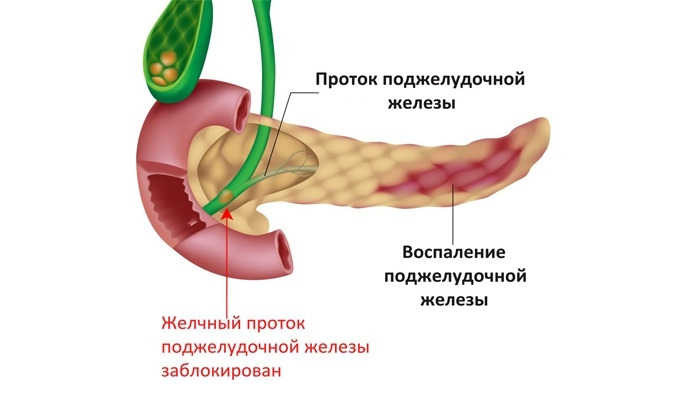 Где Находится Панкреатит У Человека Фото