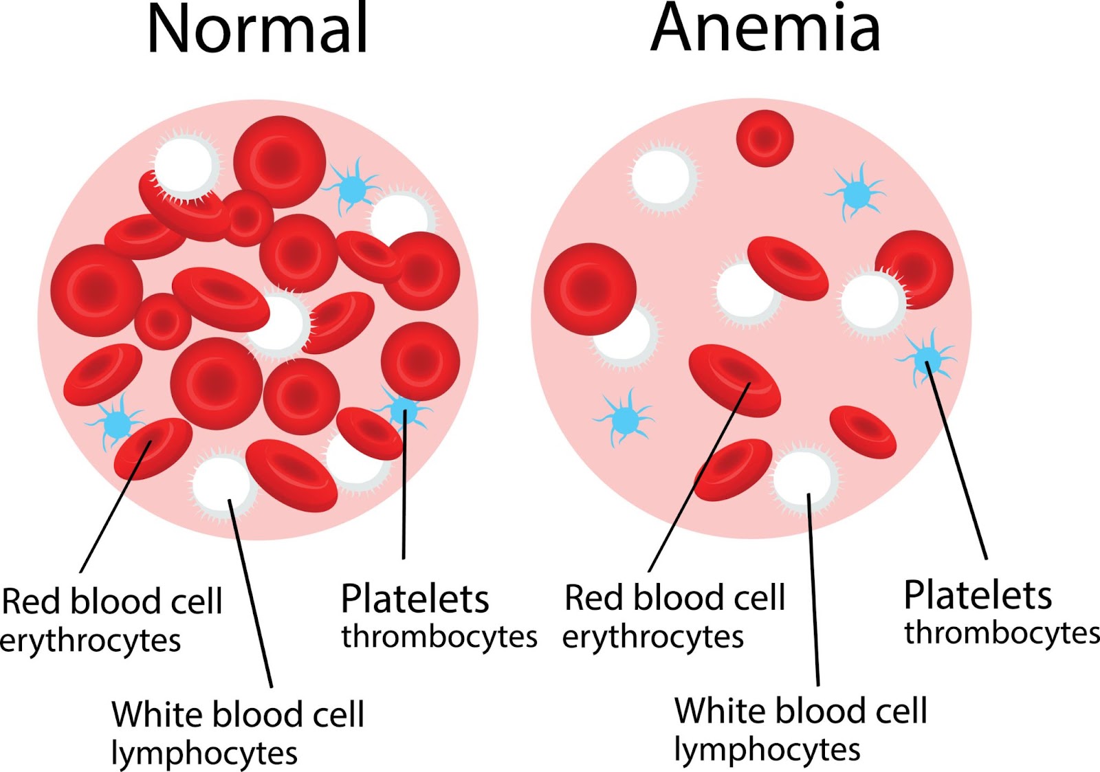 Anemia ឬ បញ្ហាខ្វះឈាមក្រហម