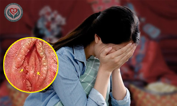 kinh nghiệm chữa sùi mào gà