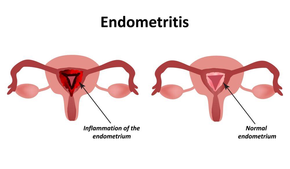 What Is Endometritis? Symptoms, Causes & Treatment