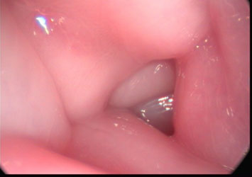 Hystreroscopic view of a normal bubaline uterus.