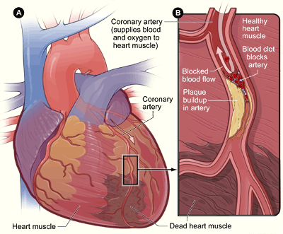 Heart With Muscle Damage and a Blocked Artery