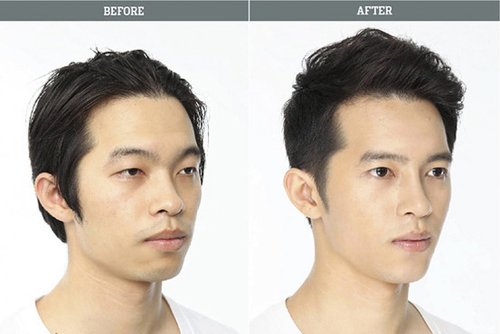 tỷ lệ phẫu thuật thẩm mỹ ở Hàn Quốc của nam giới đang có chiều hướng gia tăng.