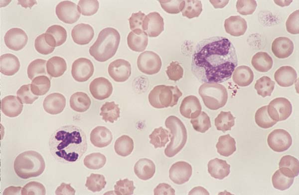 Canine monocytes. Monocytes are slightly larger than a neutrophil and have a blue-grey cytoplasm, lobulated nucleus, and a lacy chromatin pattern. A segemented neutrophil (left) and a monocyte (right).
