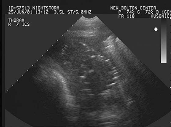 Sonographic appearances of free gas echoes within the pleural fluid of horse with severe pleuropneumonia.