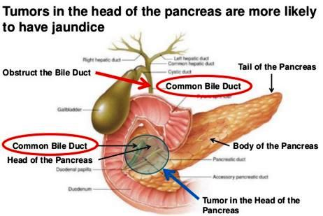 tumors jaundice and the bile duct cancer