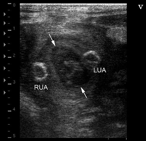 Urachal abscess with left and right omphaloarteritis