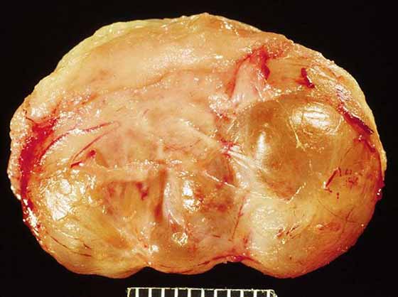 A close up view of the cut surface of the subepiglottic cyst. Many of these cysts are multiloculated.