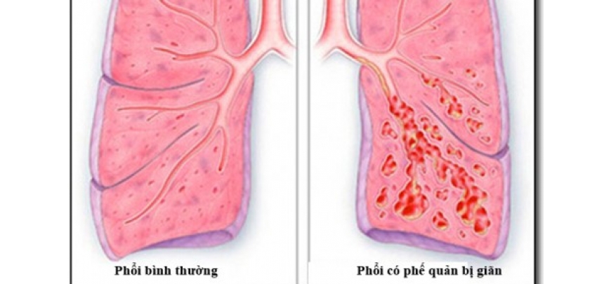 Giãn phế quản có thể khiến người bệnh bị ho ra máu