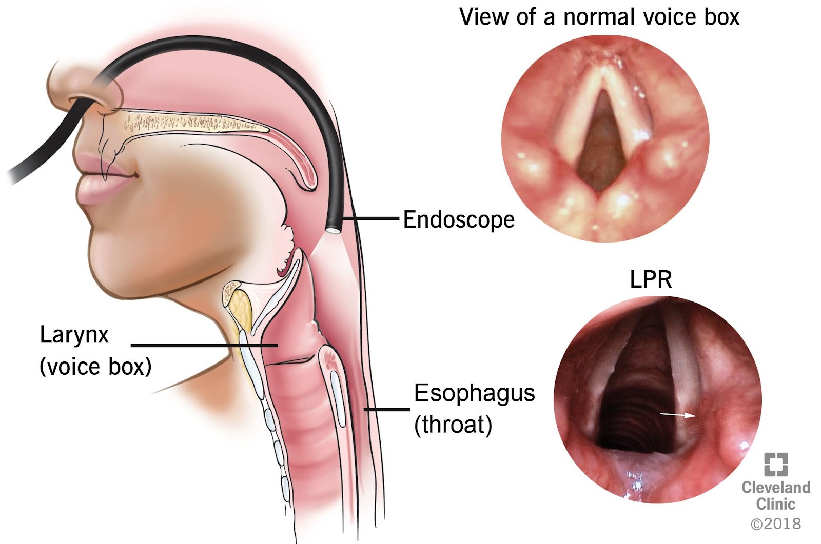 View of normal voice box | Cleveland Clinic
