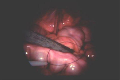 Lazo ligador en el abdomen con el instrumento sujetador colocado a través del lazo.