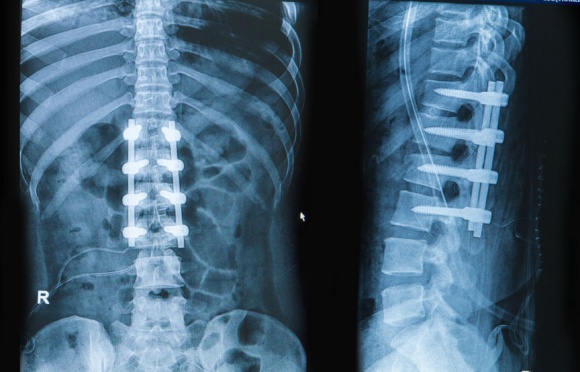 spinal-fusion-surgery