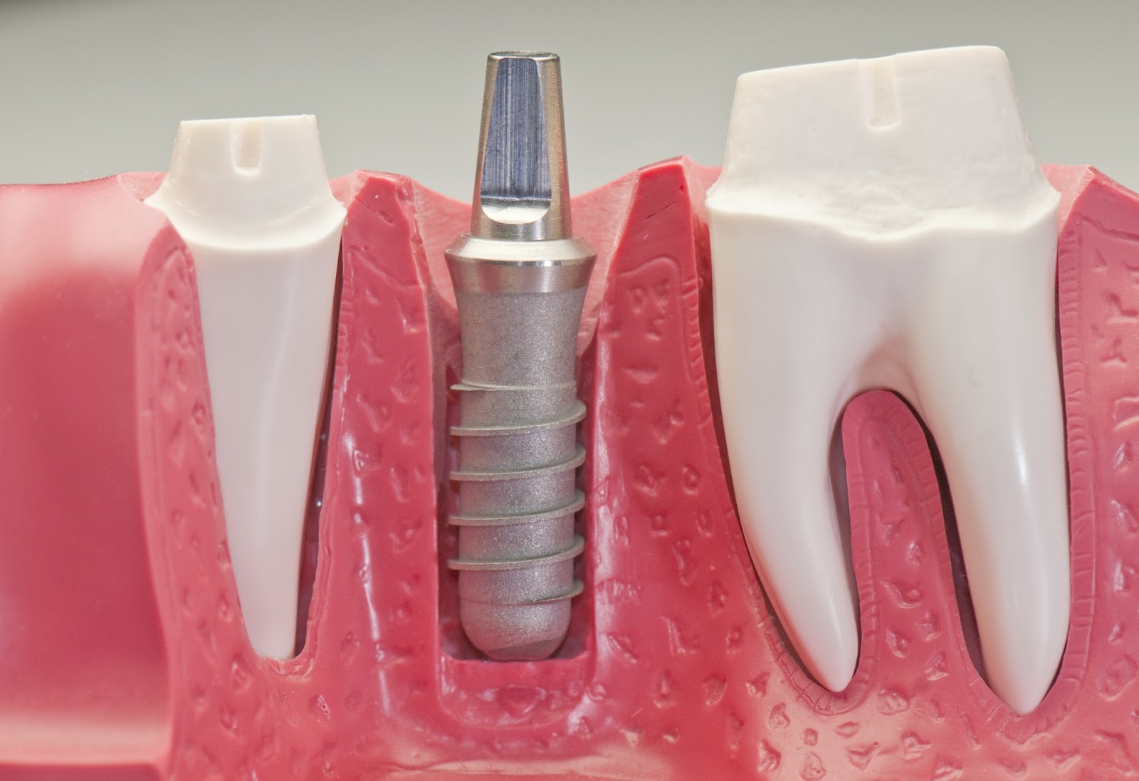 giá răng implant;bảng giá cấy ghép implant;làm răng implant;cấy ghép implant răng;giá tiền trồng răng implant;bảng giá làm răng implant;trồng implant