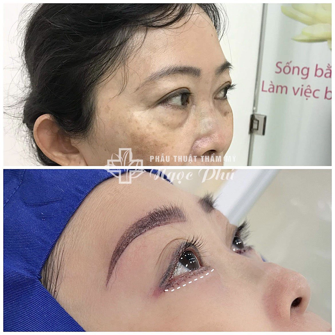 Nâng cung chân mày giá bao nhiêu còn phụ thuộc vào từng trường hợp khác nhau.