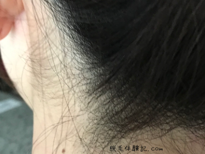 うなじ 脱毛 ビフォーアフター 863773-うなじ 脱毛 ビフォーアフター
