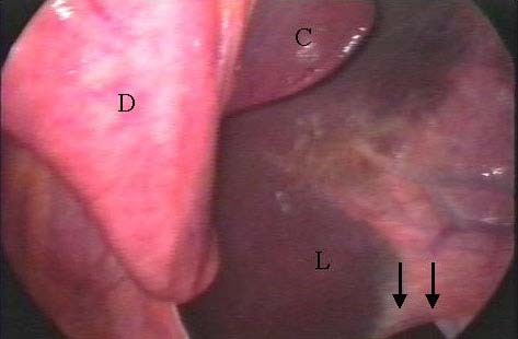 Laparoscopía en estación, vista craneal del lado derecho. D: duodeno; L: lóbulo derecho del hígado; C: lóbulo caudal del hígado; flecha: ligamento triangular.