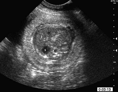 Day 52 fetal abdomen in transverse section