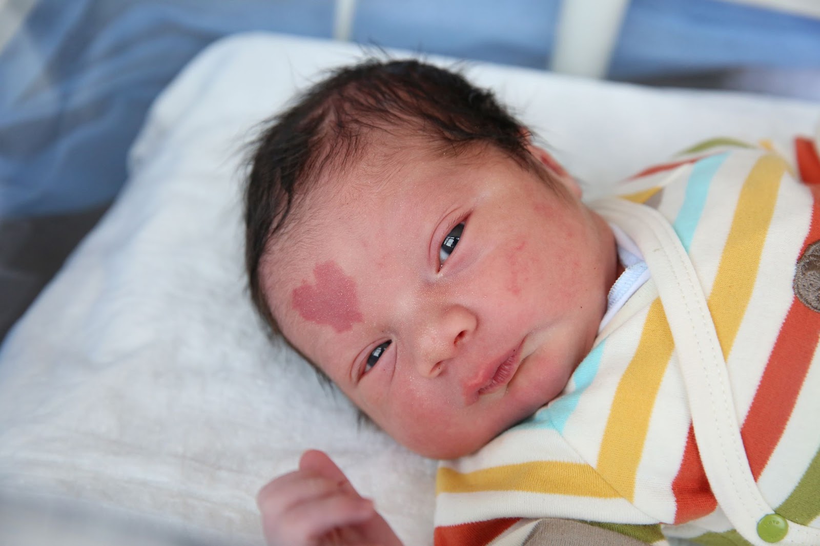 Çinar Engin, the"Love Baby" with the heart-shaped birthmark