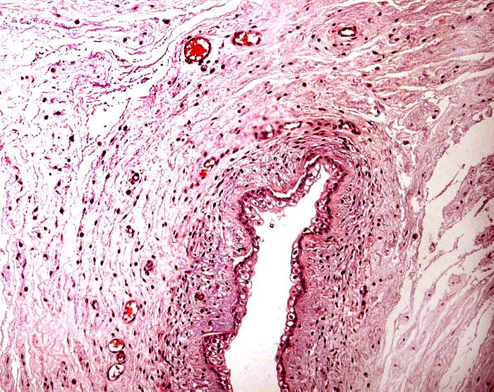 Allantoic duct in umbilical cord of immature placenta.